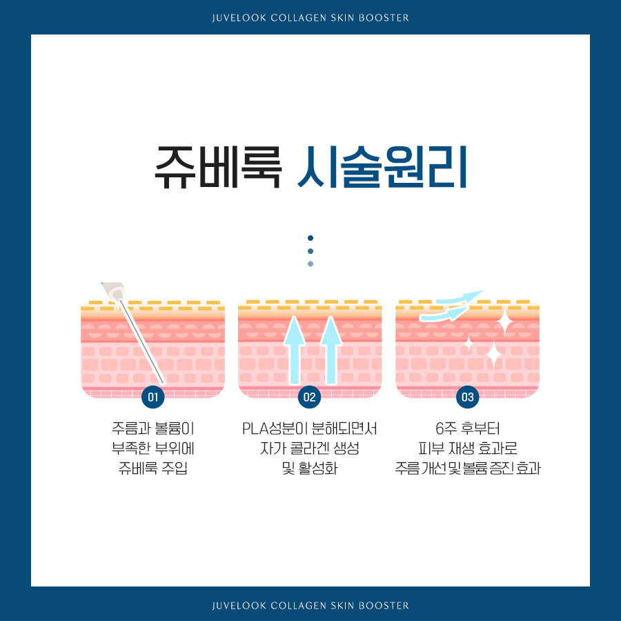 쥬베룩 주입 후 PDLLA 분해와 자가 콜라겐 생성 원리 이미지