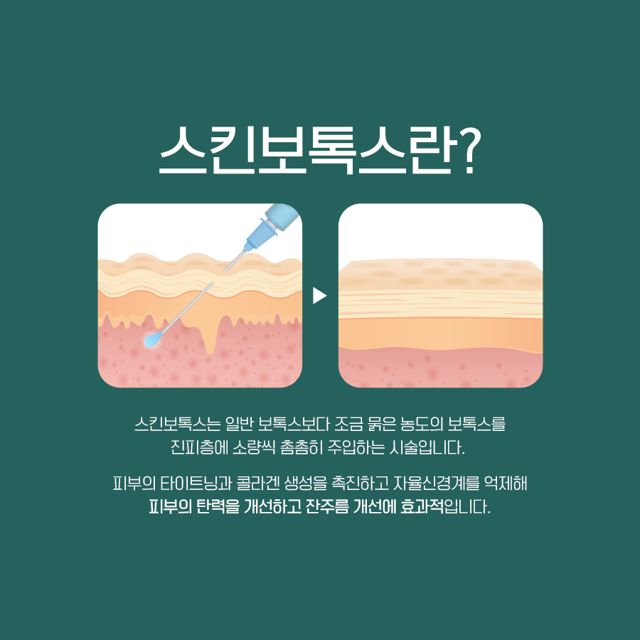 스킨보톡스를 피부의 얕은 층에 미세하게 주입하는 원리 이미지